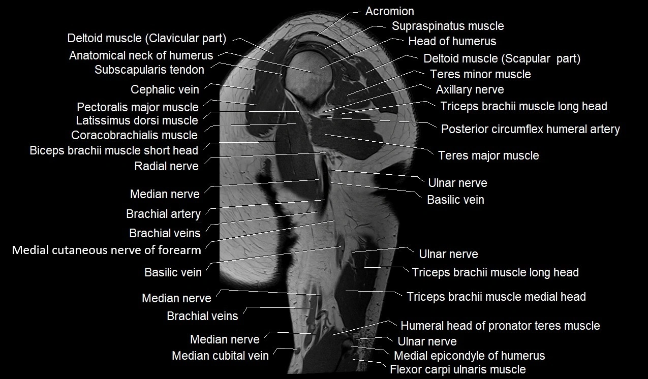 Upper arm (humerus ) saittal cross sectional anatomy 3T image 22.webp